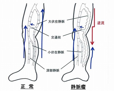 静脈瘤